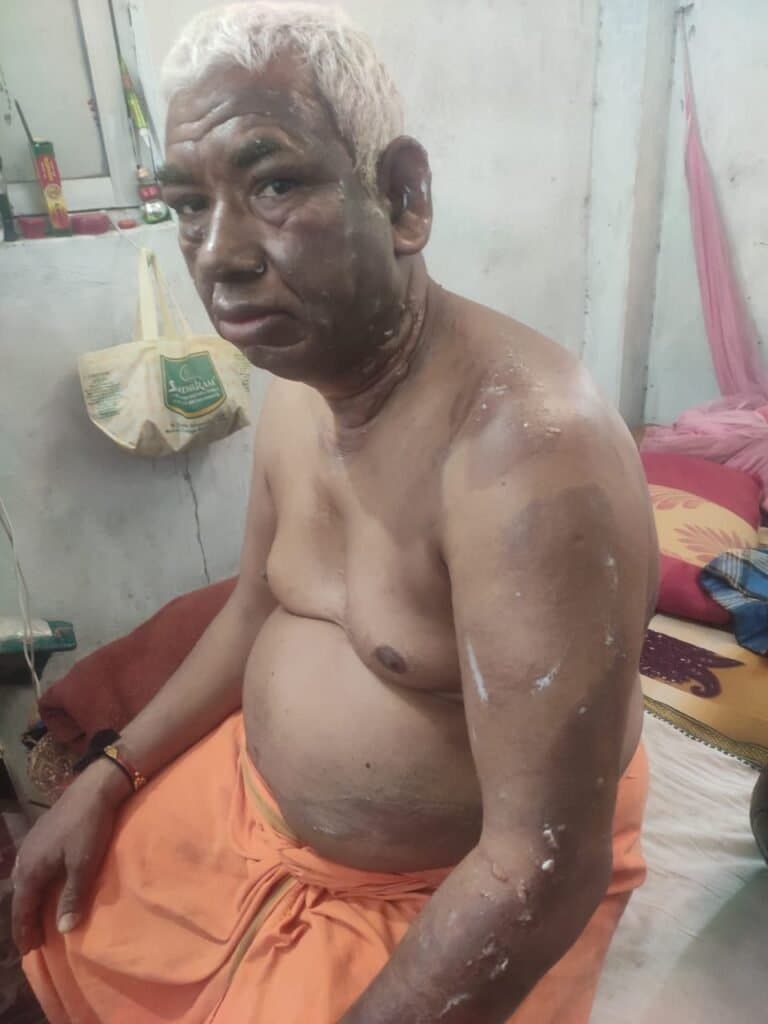 गैंस पाइपलाइन के लिकेज से बुरी तरह झुलस गया टी स्टॉल का दुकानदार