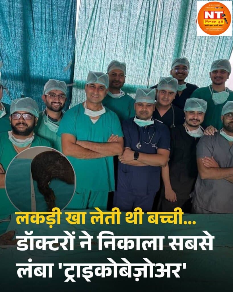 लकड़ी का लेती थी बच्ची, डॉक्टरों ने निकाला सबसे लंबा ट्राइकोबेजोअर