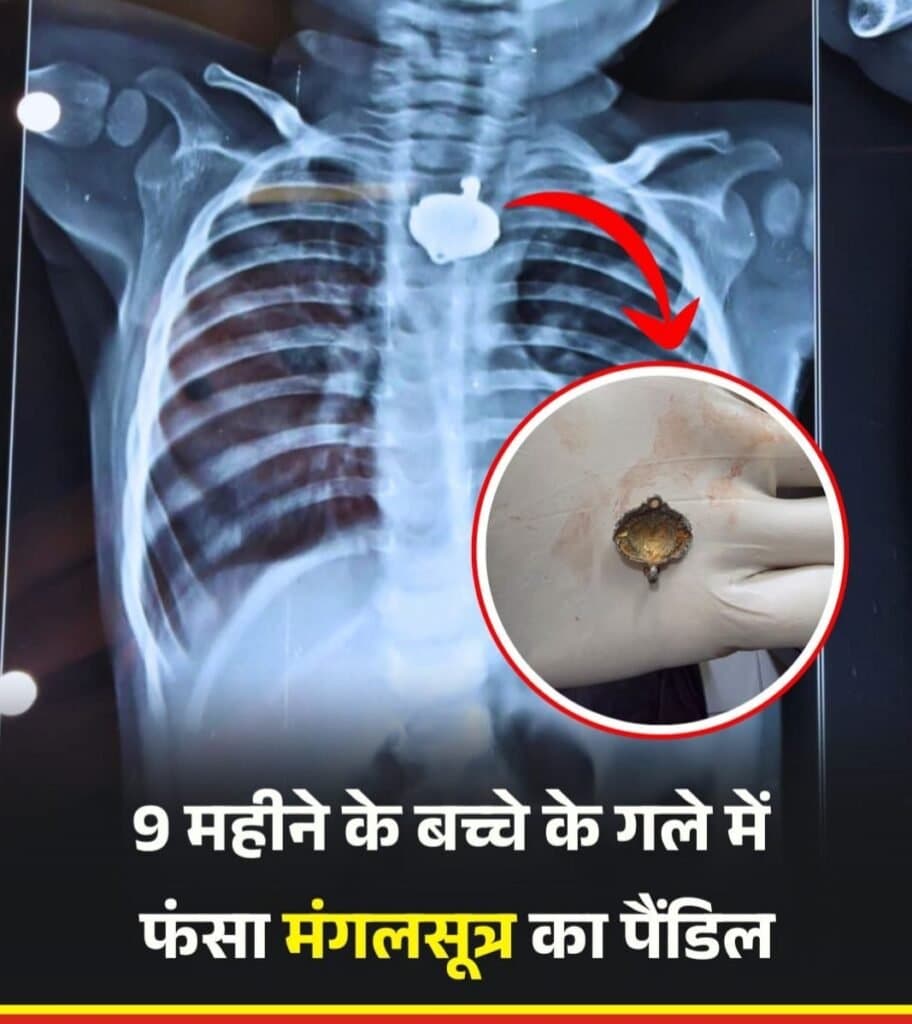 रिपोर्ट में बच्चे के गले में मंगलसूत्र का पेंडेंट फंसा हुआ पाया गया